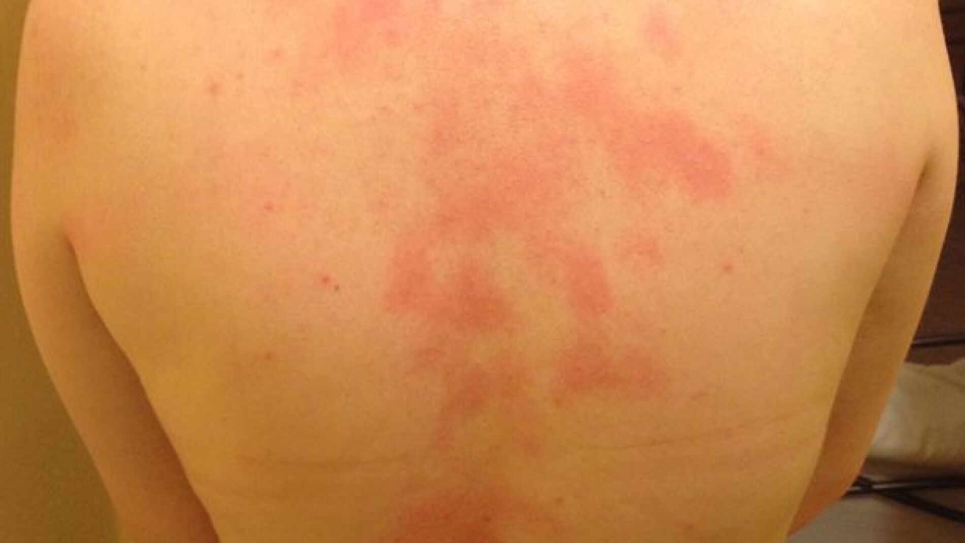 La espalda de Kerrie, tras entrar en contacto con agua