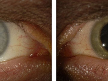 El antes y el después del ojo infectado por ébola