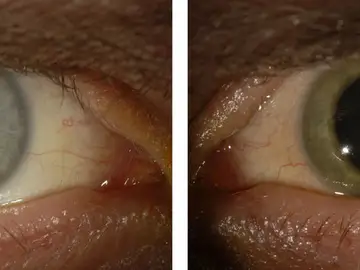 El antes y el después del ojo infectado por ébola El antes y el después del ojo infectado por ébola
