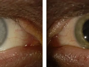 El antes y el después del ojo infectado por ébola El antes y el después del ojo infectado por ébola