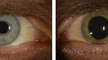 El antes y el después del ojo infectado por ébola