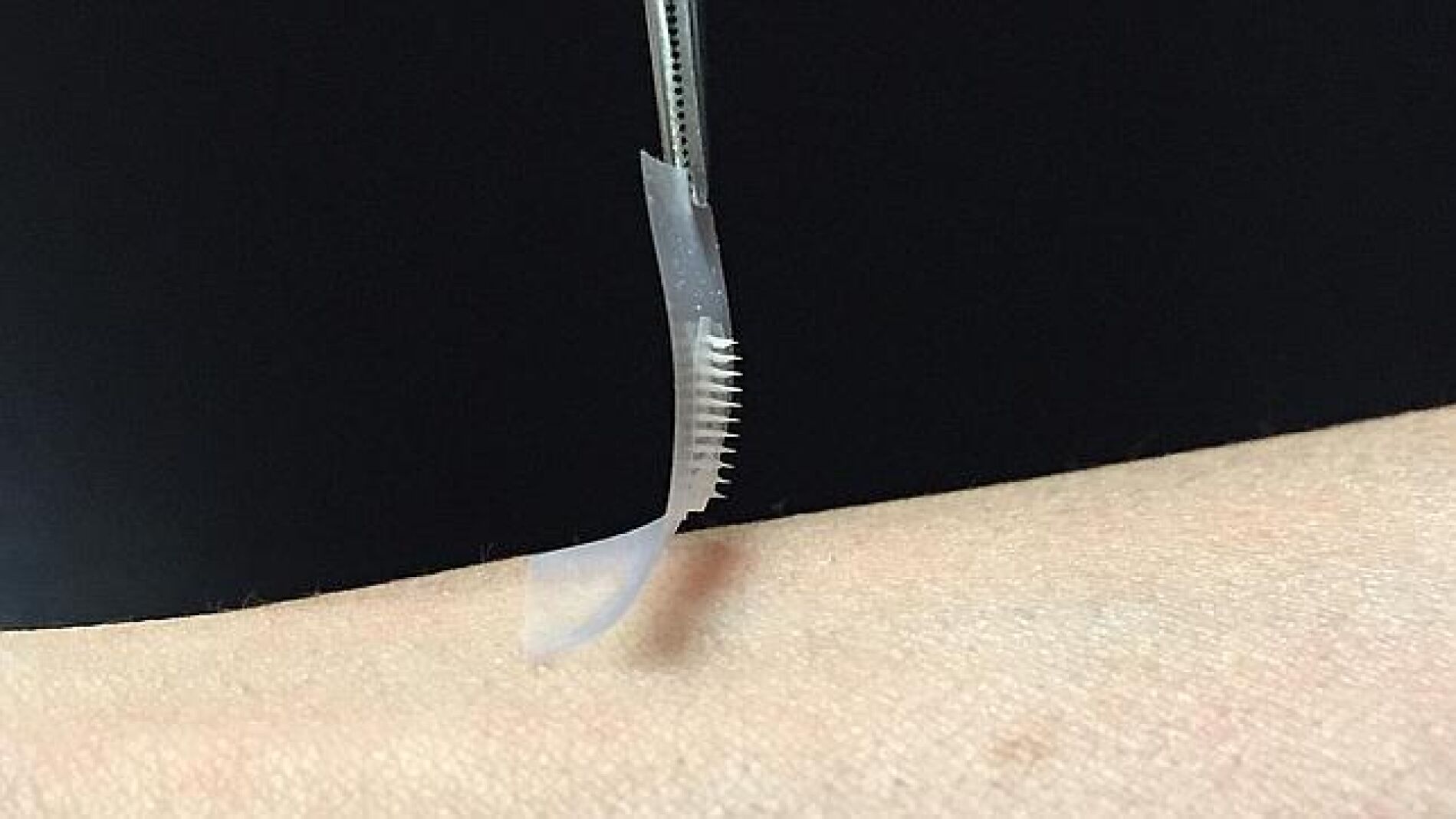 Parche de insulina con microagujas