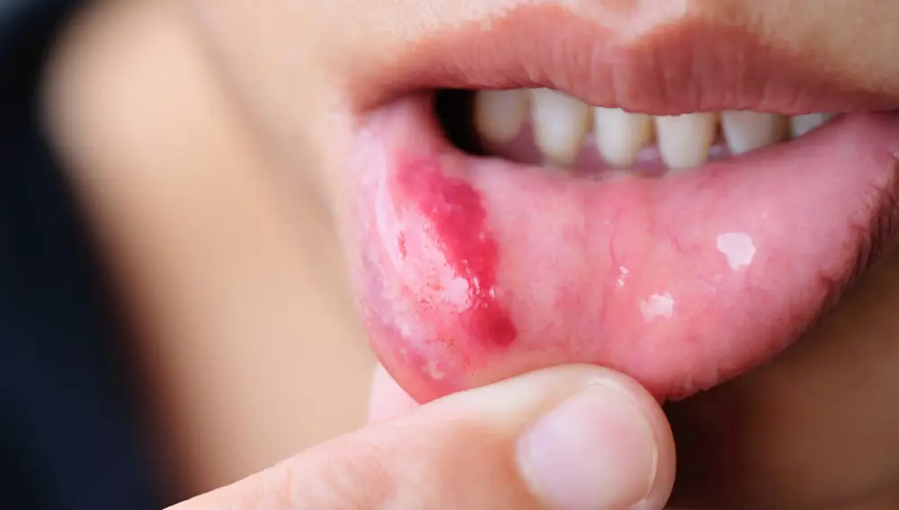 Labio con herpes simple. / Fotolia