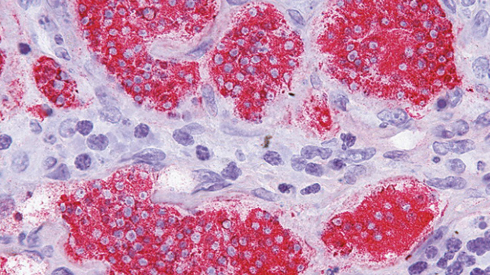Cáncer por un virus intestinal Cáncer por un virus intestinal