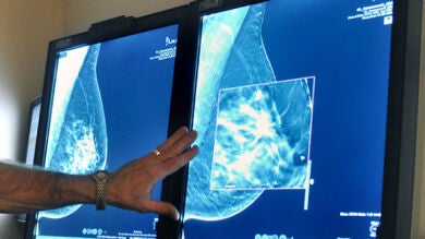 El Servicio Madrileño de Salud, condenado a pagar 140.000 euros a una mujer por el retraso en el diagnóstico de un cáncer de mama