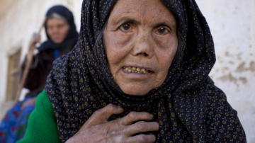 Una mujer afectada por la lepra