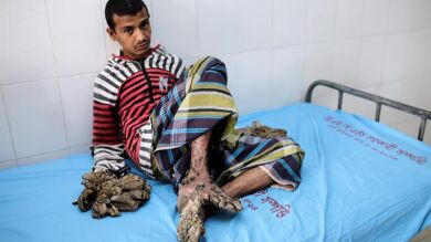 Bangladesh constituye un equipo de especialistas para intentar operar al 'hombre árbol'