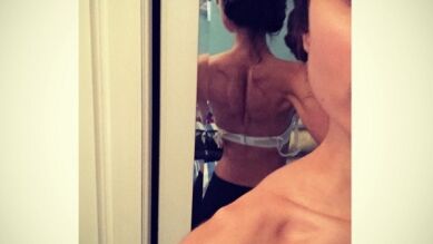 Una joven se recupera de la anorexia tras romperse una costilla al abrazar a su novio