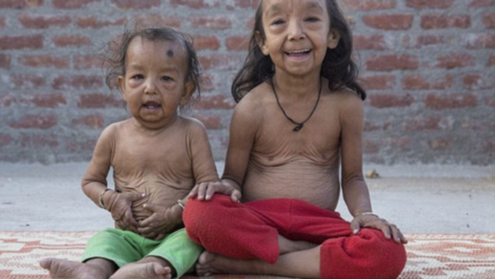 Una extraña enfermedad hace que dos niños parezcan ancianos
