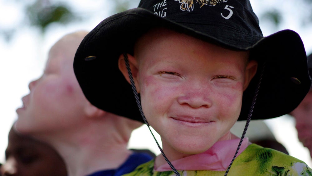 Un niño albino se protege del sol con un sombrero