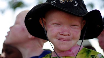 Un niño albino se protege del sol con un sombrero