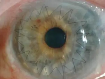 Imagen de un ojo después de un trasplante de córnea Imagen de un ojo después de un trasplante de córnea