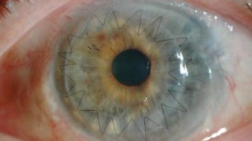 Imagen de un ojo después de un trasplante de córnea