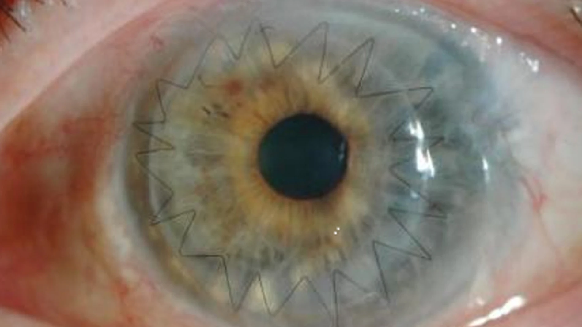 Imagen de un ojo después de un trasplante de córnea Imagen de un ojo después de un trasplante de córnea