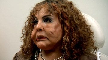 mujer con cemento inyectado