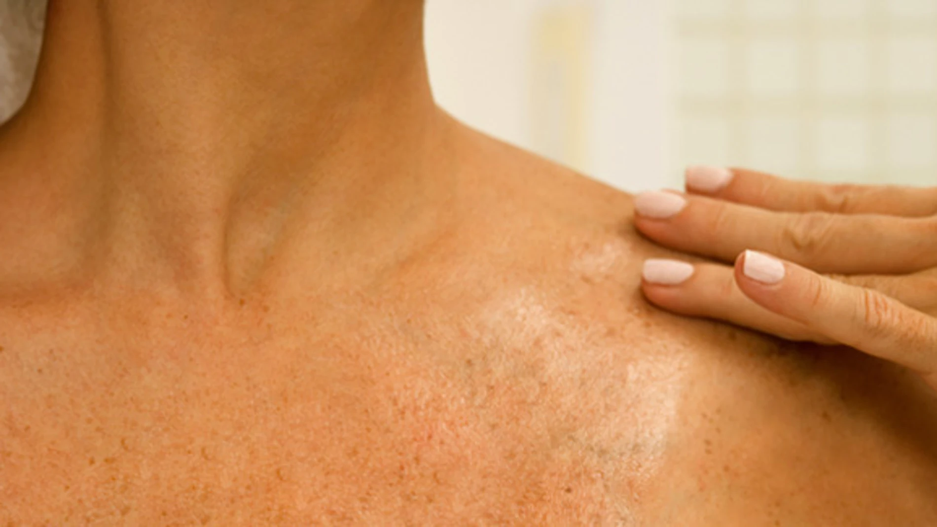 La lucha contra el cáncer de piel La lucha contra el cáncer de piel