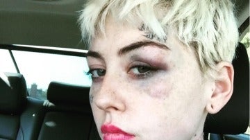 Illma Gore con las marcas del puñetazo recibido en la cara