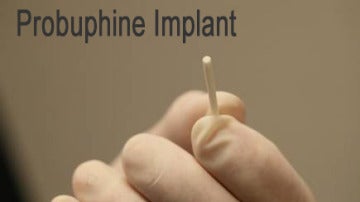 Probuphine Implant