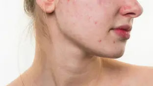 Una mujer con acné Una mujer con acné