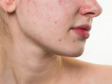 Una mujer con acné Una mujer con acné