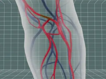Frame 42.785012 de: Detectan por primera vez en España el consumo de una nueva droga, 'krokodil' Frame 42.785012 de: Detectan por primera vez en España el consumo de una nueva droga, 'krokodil'