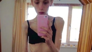 La joven anoréxica