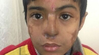 Los médicos reimplantan la nariz a un niño después de hacerla crecer en su propia frente