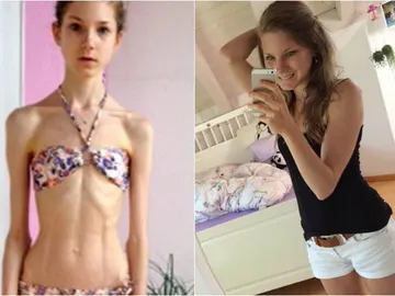 Chiara Schober, durante su enfermedad (i) y una vez superada (d) Chiara Schober, durante su enfermedad (i) y una vez superada (d)