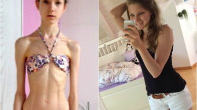 Una joven con anorexia que llegó a pesar 22 kilos se recupera gracias a su novio