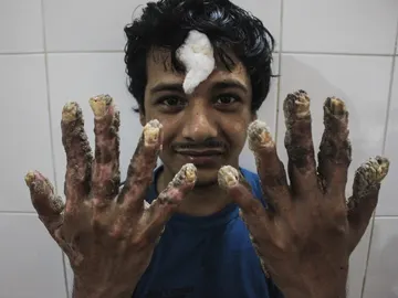 Abul Bajandar, conocido como el hombre árbol Abul Bajandar, conocido como el hombre árbol