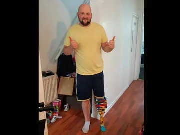 Marc Cronin con su pierna de Lego Marc Cronin con su pierna de Lego
