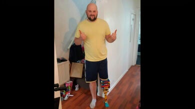 Un hombre se construye una pierna de Lego mientras espera su prótesis 