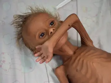 Un niño yemení desnutrido Un niño yemení desnutrido