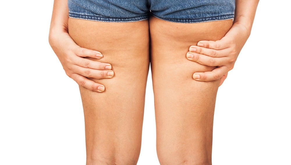 Celulitis en las piernas