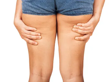 Celulitis en las piernas Celulitis en las piernas