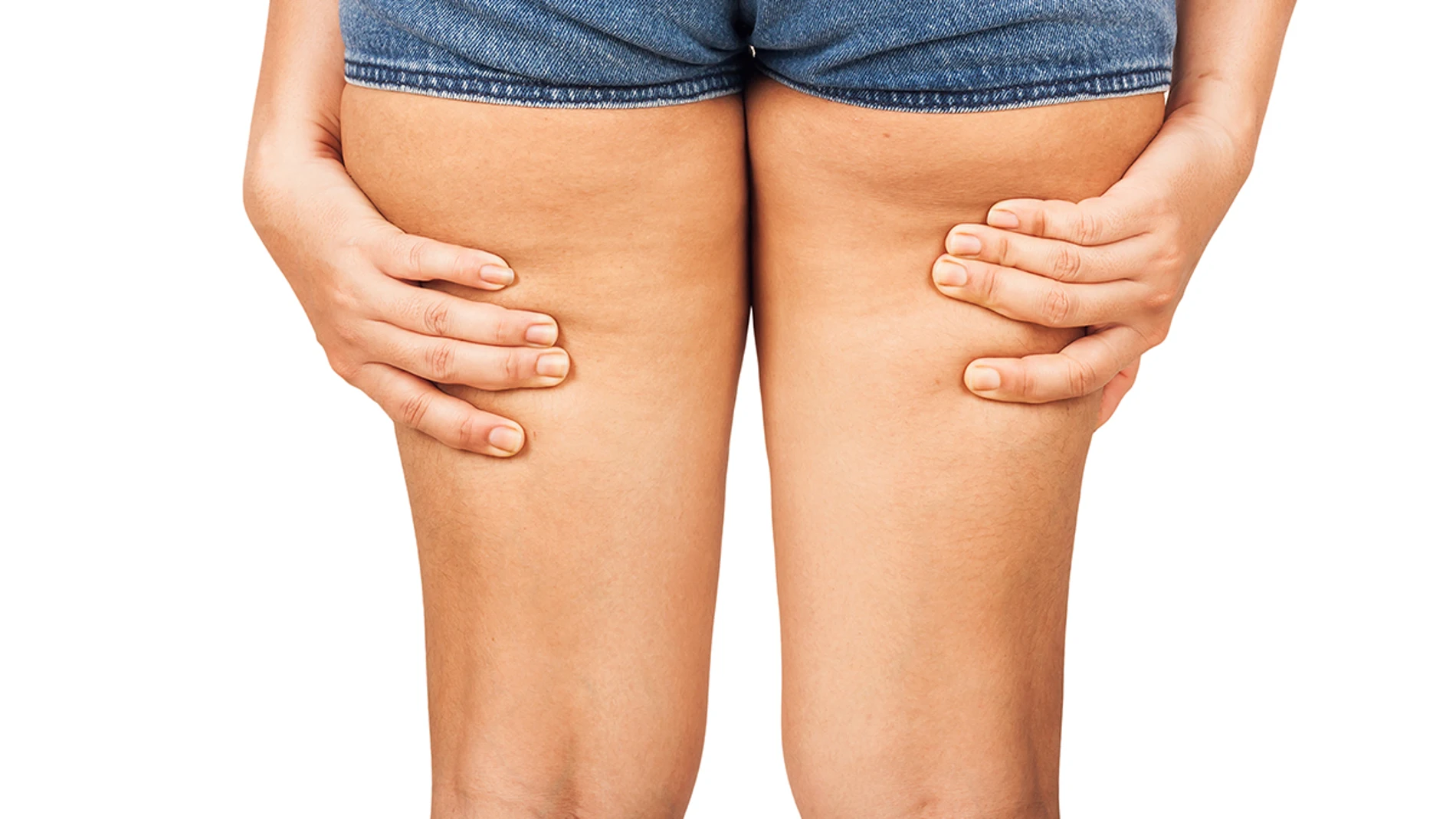 Celulitis en las piernas Celulitis en las piernas