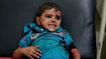 Un niño herido en Alepo