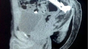 Radiografía en la que se muestra la extraña cola del adolescente