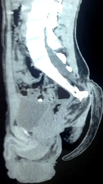 Radiografía en la que se muestra la extraña cola del adolescente Radiografía en la que se muestra la extraña cola del adolescente