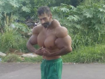 Valdir Segato, el hombre que se inyecta aceite para que sus bíceps crezcan