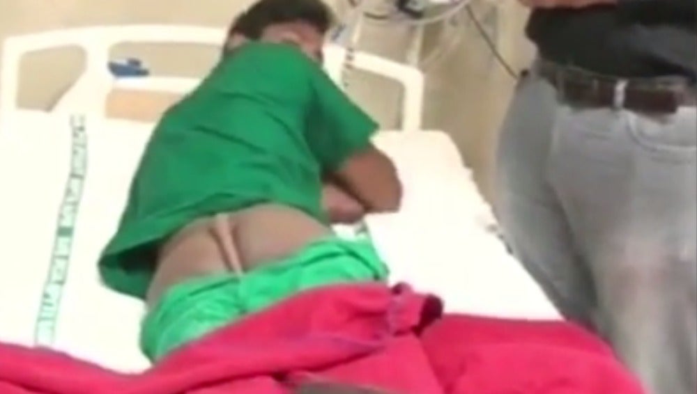 El joven de 18 años,nació con una cola parecida a la de un animal