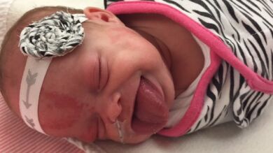Una niña de un año sonríe por primera vez tras someterse a una operación para reducir el tamaño de su lengua