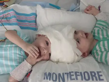 Bebés siameses Bebés siameses