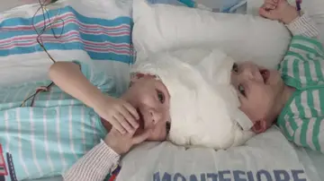 Bebés siameses Bebés siameses