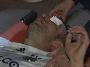 Van Persie, tras sufrir el codazo que casi le hace perder un ojo Van Persie, tras sufrir el codazo que casi le hace perder un ojo
