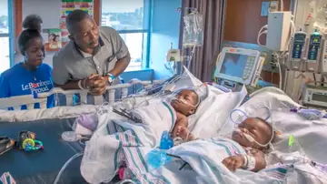 Las gemelas tras la operación Las gemelas tras la operación