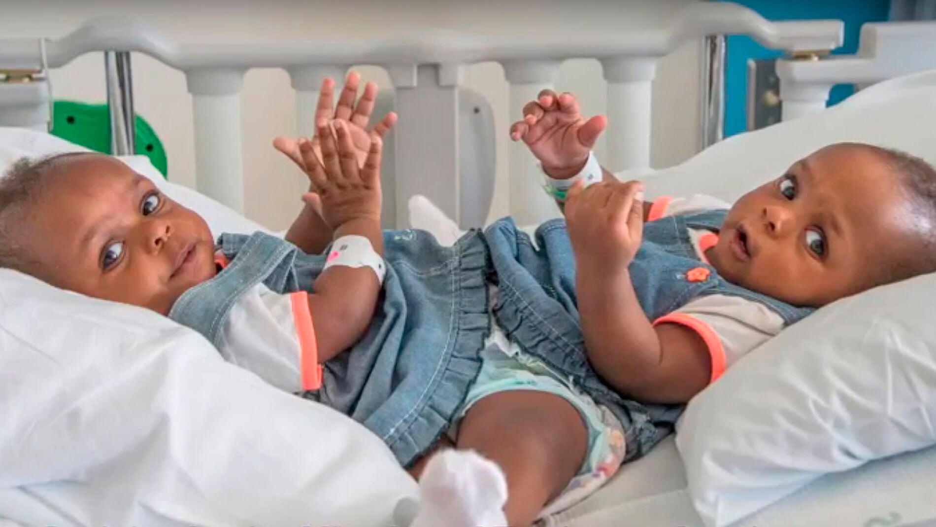 Las siamesas unidas antes de operaci&oacute;n 