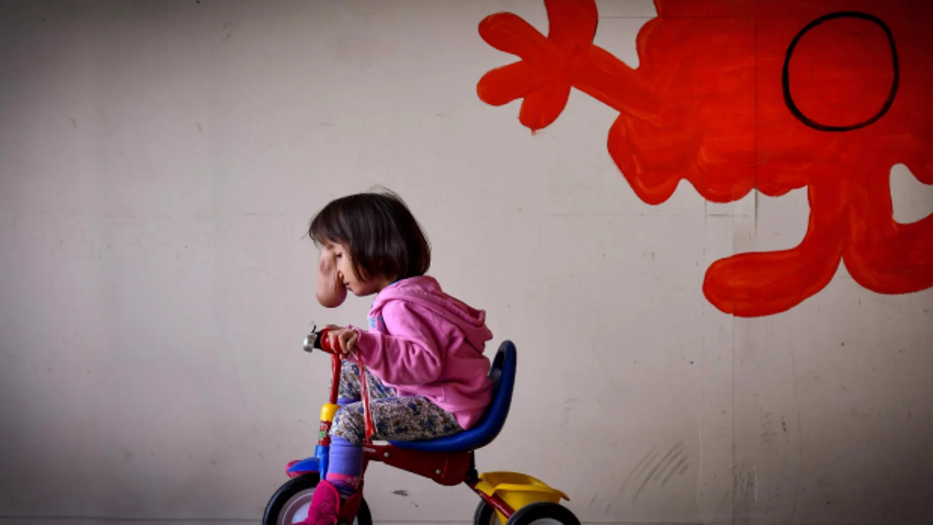 La pequeña Ángel antes de su operación La pequeña Ángel antes de su operación