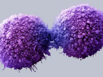 Células de páncreas cancerosas completando la división celulas Células de páncreas cancerosas completando la división celulas
