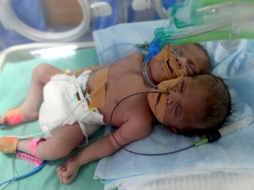 Las dos gemelas siamesas nacidas en Gaza